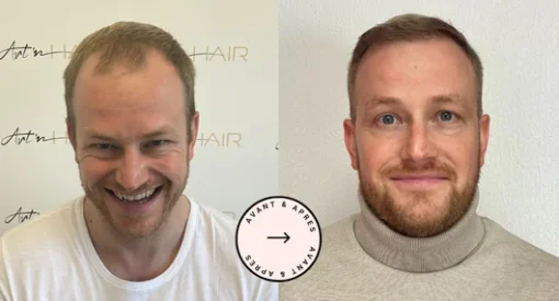 greffe de cheveux fabian
